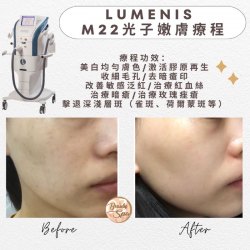 Lumenis M22光子嫩膚療程