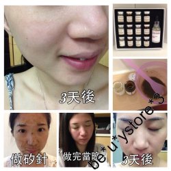 英國 Dermier 海藻矽針煥膚療程 單set