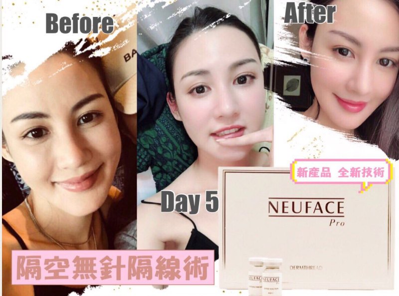 韓國 Neuface 隔空埋線療程 韓國 Neuface 隔空埋線療程