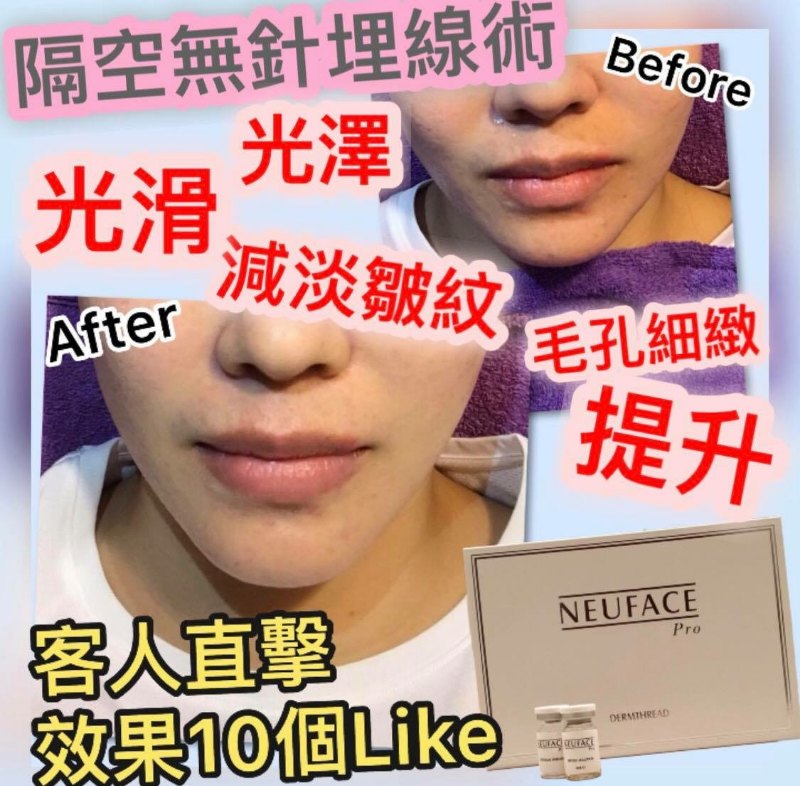 韓國 Neuface 隔空埋線療程 韓國 Neuface 隔空埋線療程