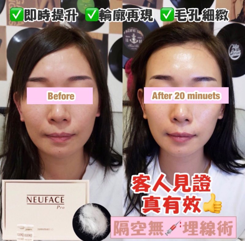 韓國 Neuface 隔空埋線療程 韓國 Neuface 隔空埋線療程