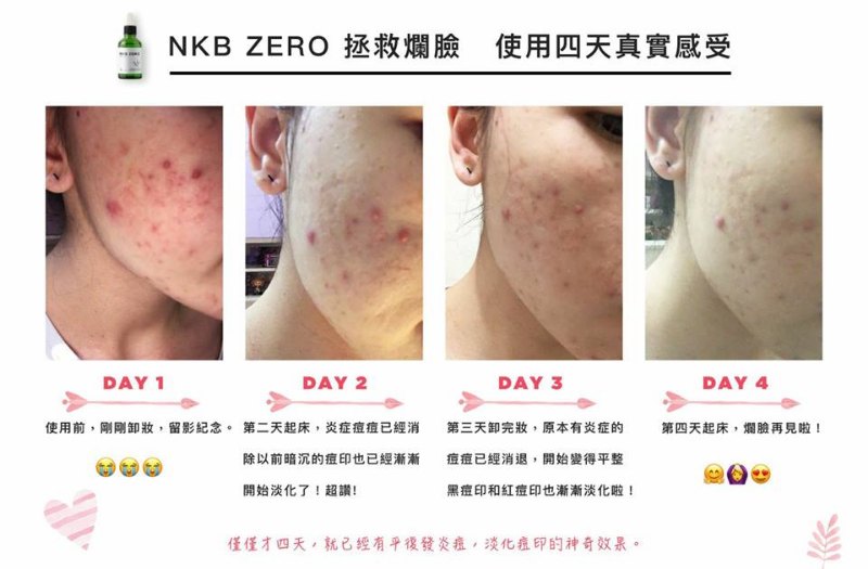 日本Hery Nkb 綠寶寶抗痘精華 29ml 日本Hery Nkb 綠寶寶抗痘精華 29ml