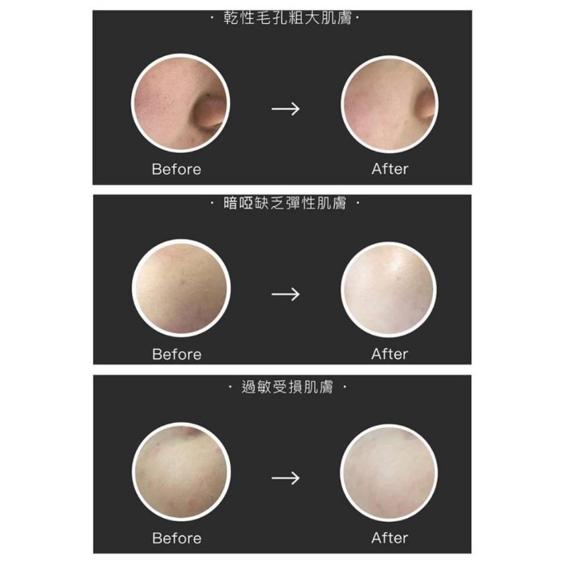 韓國 SMTS 幹細胞嬰兒水晶針療程套裝 韓國 SMTS 幹細胞嬰兒水晶針療程套裝