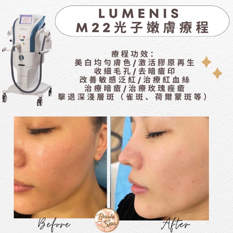 Lumenis M22光子嫩膚療程