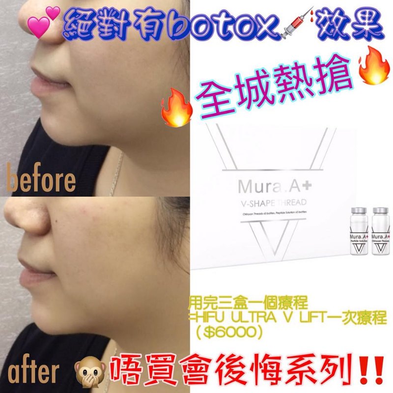 日本Mura A+隔空手術無針埋線 日本Mura A+隔空手術無針埋線
