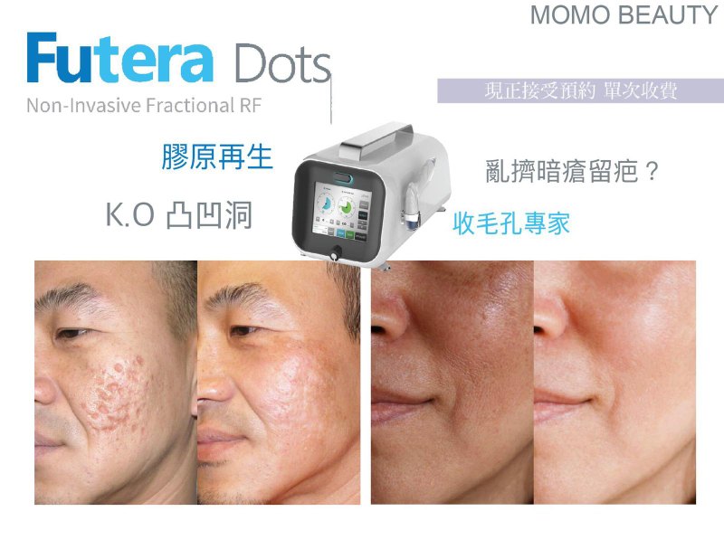 Futera Dots 全新科技膠原收毛孔專家 Futera Dots 全新科技膠原收毛孔專家