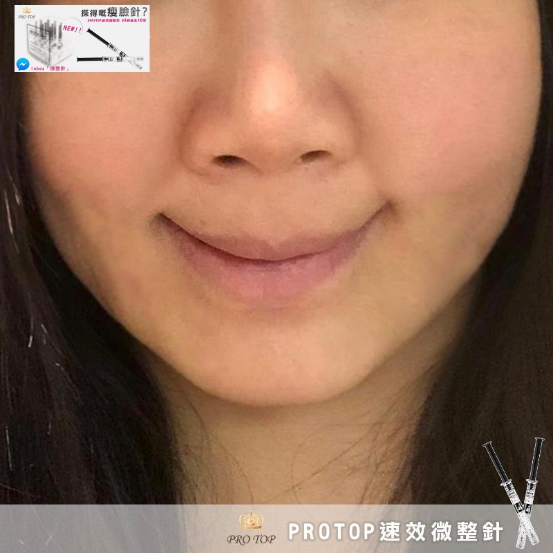 Protop 神奇緊緻速效針 (2.5ml*10) Protop 神奇緊緻速效針 (2.5ml*10)